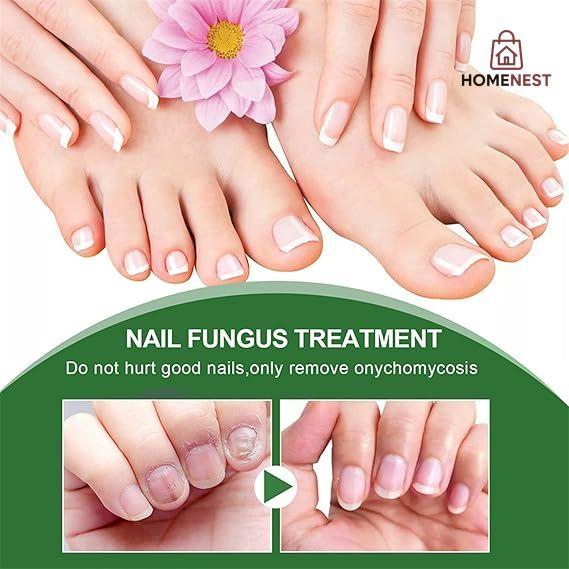Fungal Nail Treatment - Extra Strong Nail Fungus Treatment for Toenail and Fingernail - Anti fungus Nail Repair and Strengthen, Fix & Renew Damaged, Broken Nails