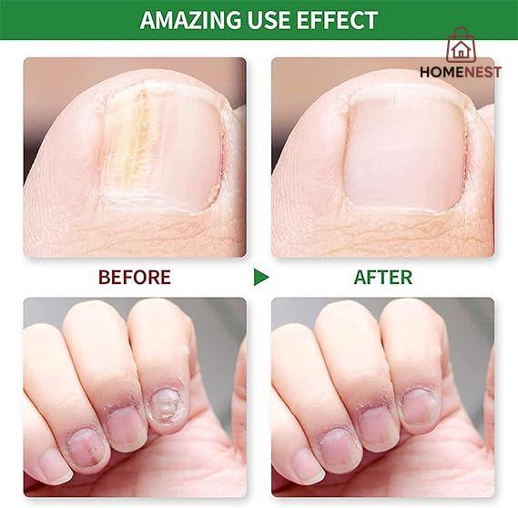 Fungal Nail Treatment - Extra Strong Nail Fungus Treatment for Toenail and Fingernail - Anti fungus Nail Repair and Strengthen, Fix & Renew Damaged, Broken Nails